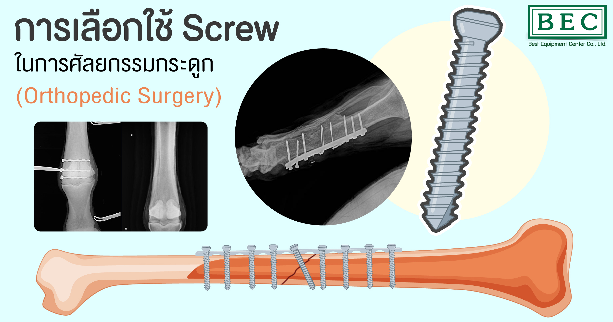 การเลือกใช้ Screw ในการศัลยกรรมกระดูก (Orthopedic Surgery) Best
